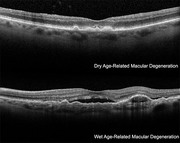 Macular Hole Treatment in NYC