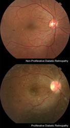 Diabetic Retinopathy in NYC